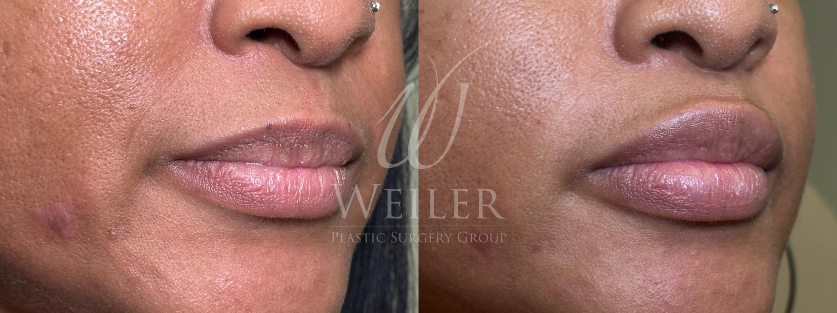 Before & After Lip Augmentation Case 1617 Right Oblique View in Baton Rouge, New Orleans, & Lafayette, Louisiana