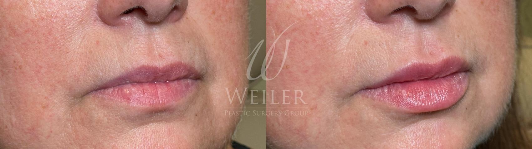 Before & After Lip Augmentation Case 1622 Right Oblique View in Baton Rouge, New Orleans, & Lafayette, Louisiana