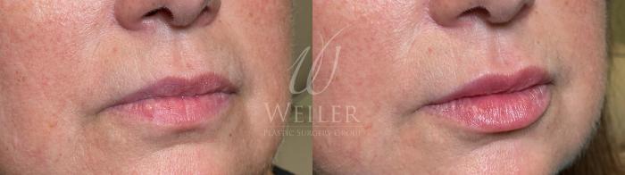 Before & After Lip Augmentation Case 1622 Right Oblique View in Baton Rouge, New Orleans, & Lafayette, Louisiana