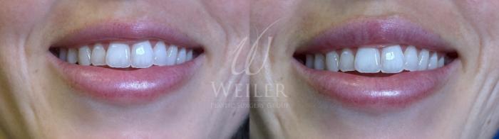 Before & After Lip Augmentation Case 1628 Front View in Baton Rouge, New Orleans, & Lafayette, Louisiana