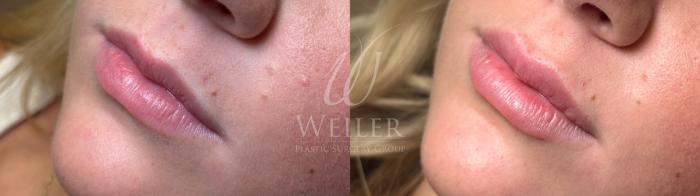 Before & After Lip Augmentation Case 1644 Front View in Baton Rouge, New Orleans, & Lafayette, Louisiana