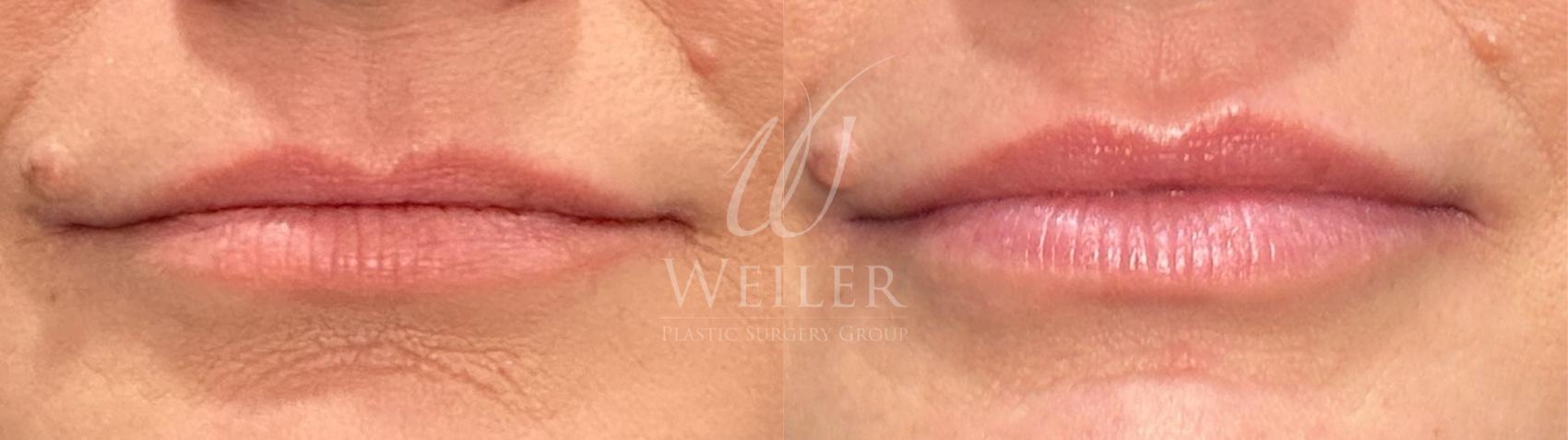 Before & After Lip Augmentation Case 1647 Front View in Baton Rouge, New Orleans, & Lafayette, Louisiana