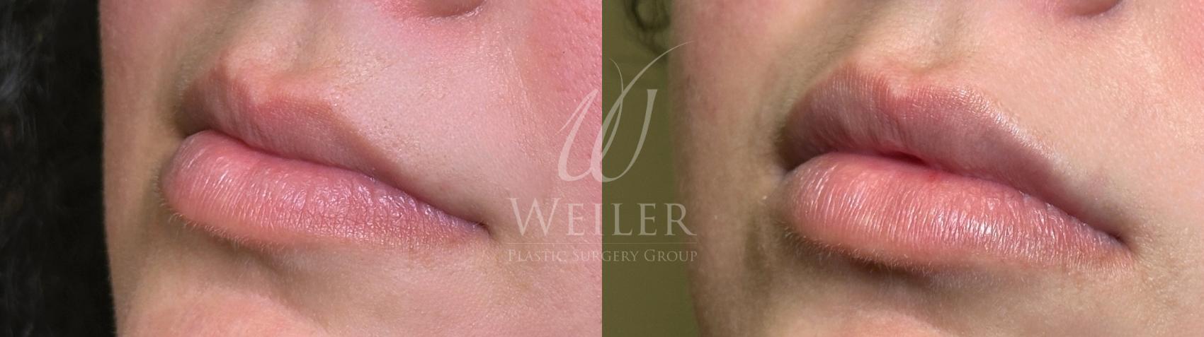 Before & After Lip Augmentation Case 1649 Front View in Baton Rouge, New Orleans, & Lafayette, Louisiana