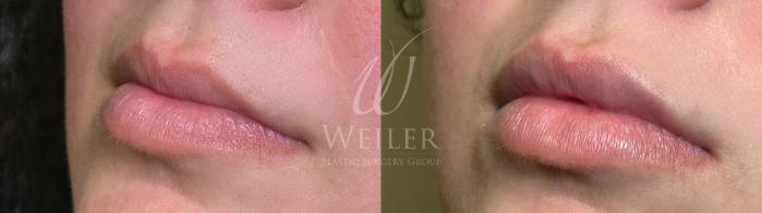Before & After Lip Augmentation Case 1649 Front View in Baton Rouge, New Orleans, & Lafayette, Louisiana