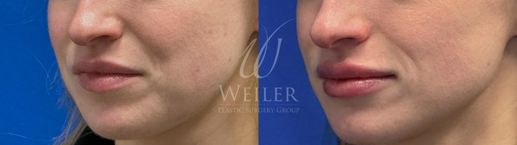 Before & After Lip Augmentation Case 1667 Left Oblique View in Baton Rouge, New Orleans, & Lafayette, Louisiana