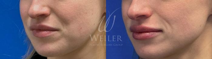 Before & After Lip Augmentation Case 1667 Left Oblique View in Baton Rouge, New Orleans, & Lafayette, Louisiana