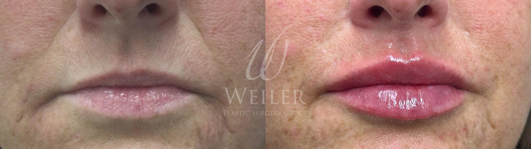 Before & After Lip Augmentation Case 1709 Front View in Baton Rouge, New Orleans, & Lafayette, Louisiana