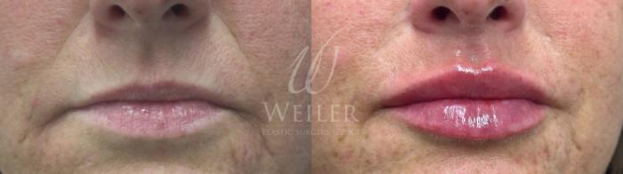Before & After Lip Augmentation Case 1709 Front View in Baton Rouge, New Orleans, & Lafayette, Louisiana