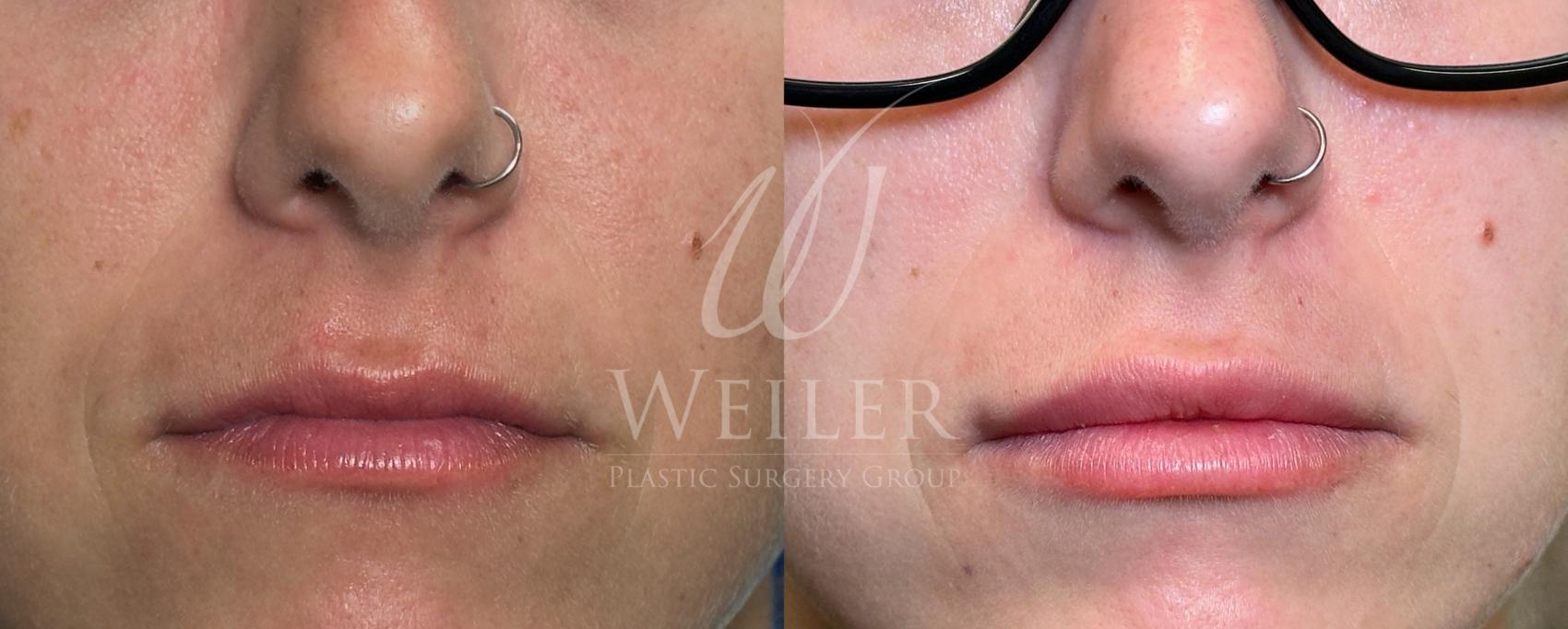 Before & After Lip Augmentation Case 1726 Front View in Baton Rouge, New Orleans, & Lafayette, Louisiana