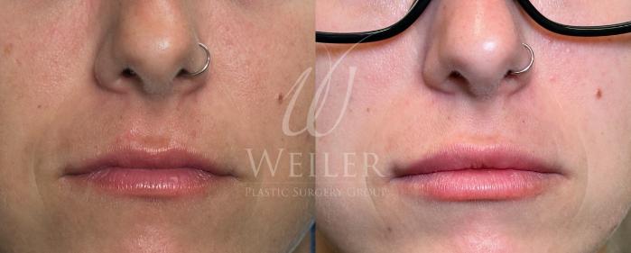 Before & After Lip Augmentation Case 1726 Front View in Baton Rouge, New Orleans, & Lafayette, Louisiana