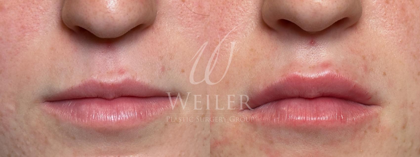 Before & After Lip Augmentation Case 1727 Front View in Baton Rouge, New Orleans, & Lafayette, Louisiana