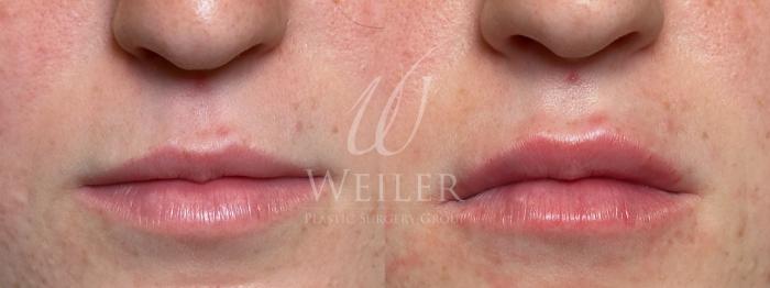Before & After Lip Augmentation Case 1727 Front View in Baton Rouge, New Orleans, & Lafayette, Louisiana
