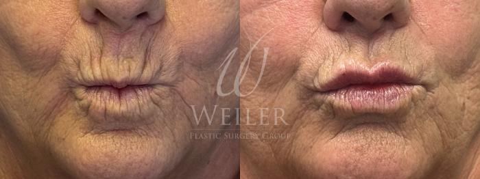 Before & After Lip Augmentation Case 1741 Front View in Baton Rouge, New Orleans, & Lafayette, Louisiana