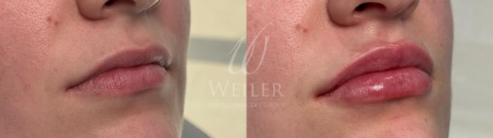 Before & After Lip Augmentation Case 1798 Right Oblique View in Baton Rouge, New Orleans, & Lafayette, Louisiana