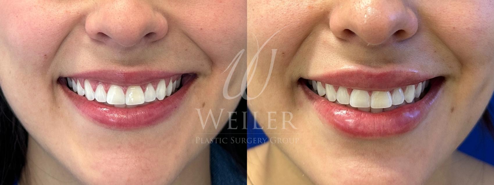 Before & After Lip Augmentation Case 1799 Front View in Baton Rouge, New Orleans, & Lafayette, Louisiana
