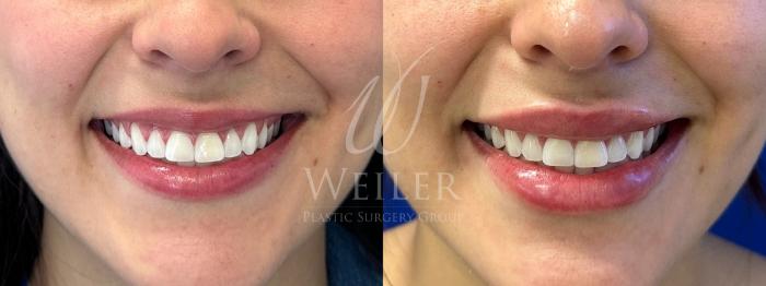 Before & After Lip Augmentation Case 1799 Front View in Baton Rouge, New Orleans, & Lafayette, Louisiana