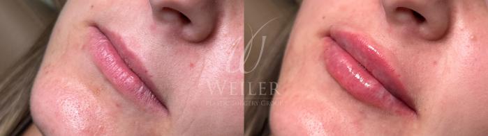 Before & After Lip Augmentation Case 1811 Left Oblique View in Baton Rouge, New Orleans, & Lafayette, Louisiana