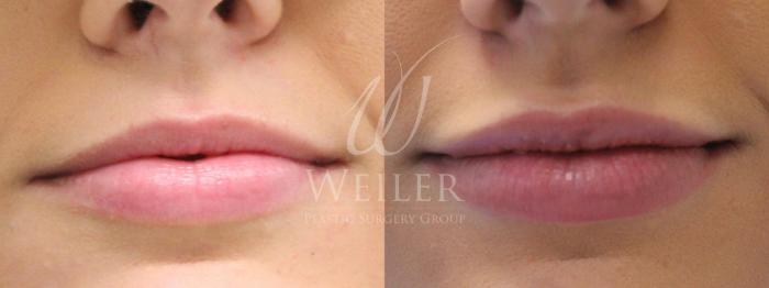 Before & After Lip Augmentation Case 204 View #1 View in Baton Rouge, New Orleans, & Lafayette, Louisiana