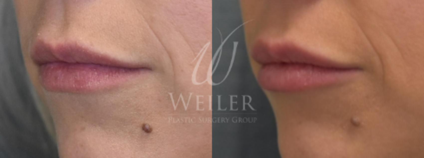 Before & After Lip Augmentation Case 270 View #1 View in Baton Rouge, Louisiana