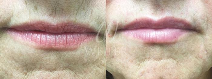 Before & After JUVÉDERM® Case 3 View #1 View in Baton Rouge, New Orleans, & Lafayette, Louisiana
