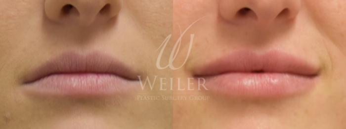Before & After Lip Augmentation Case 356 View #1 View in Baton Rouge, New Orleans, & Lafayette, Louisiana