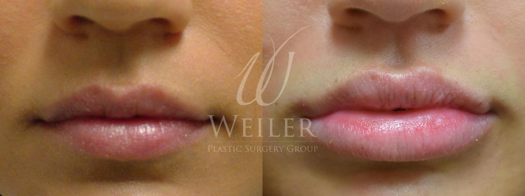 Before & After Lip Augmentation Case 357 View #1 View in Baton Rouge, Louisiana