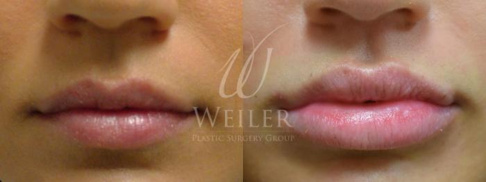 Before & After Lip Augmentation Case 357 View #1 View in Baton Rouge, New Orleans, & Lafayette, Louisiana