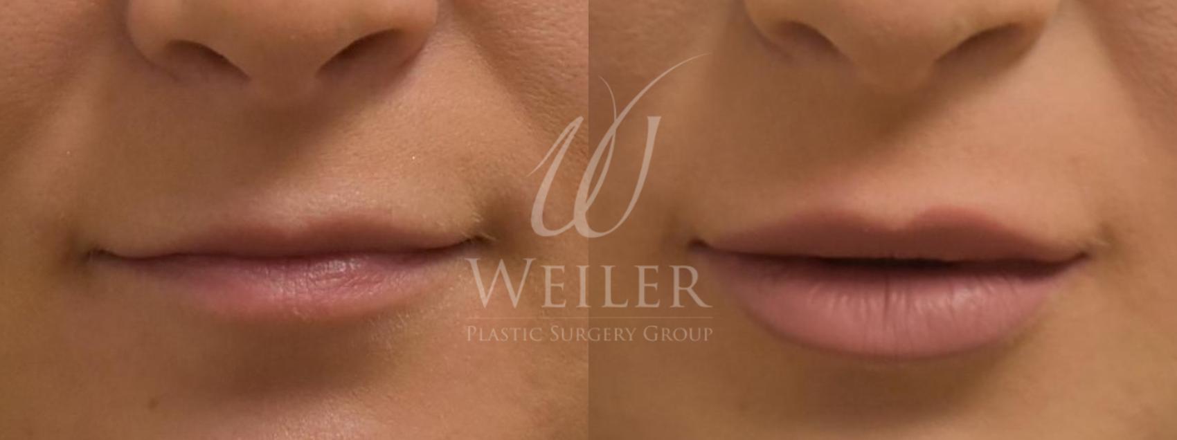 Before & After Lip Augmentation Case 363 View #1 View in Baton Rouge, Louisiana
