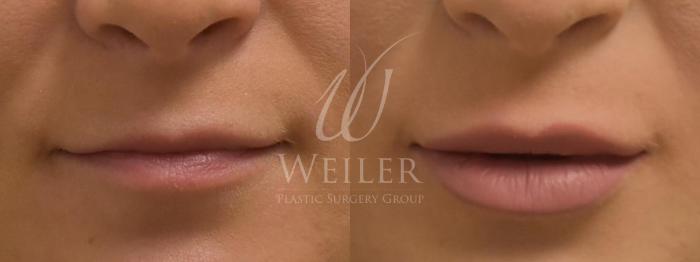 Before & After Lip Augmentation Case 363 View #1 View in Baton Rouge, New Orleans, & Lafayette, Louisiana