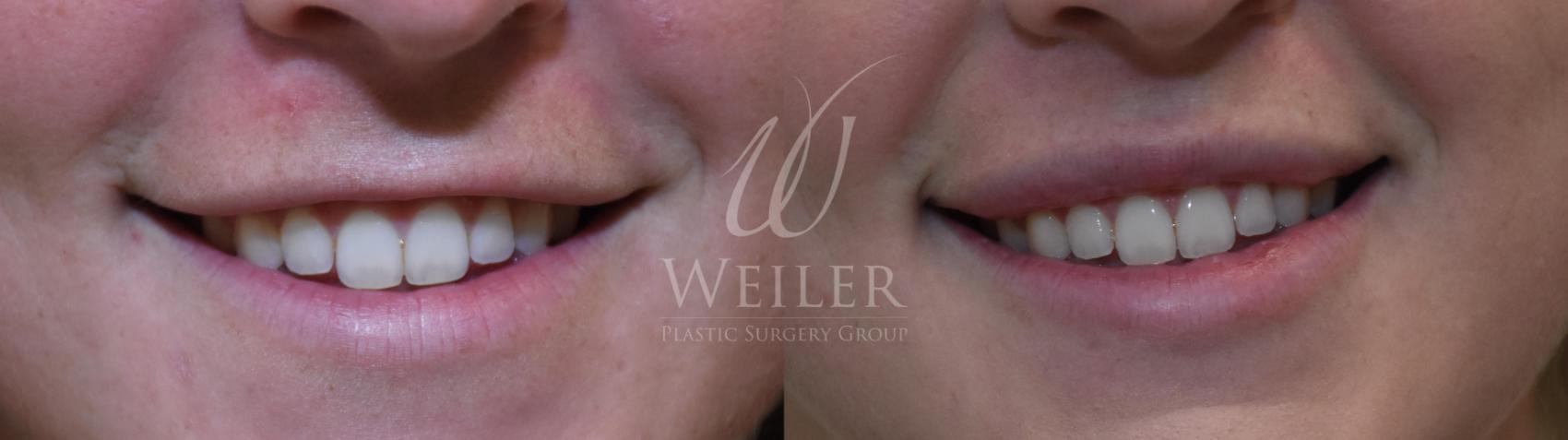 Before & After Lip Augmentation Case 502 Front View in Baton Rouge, Louisiana