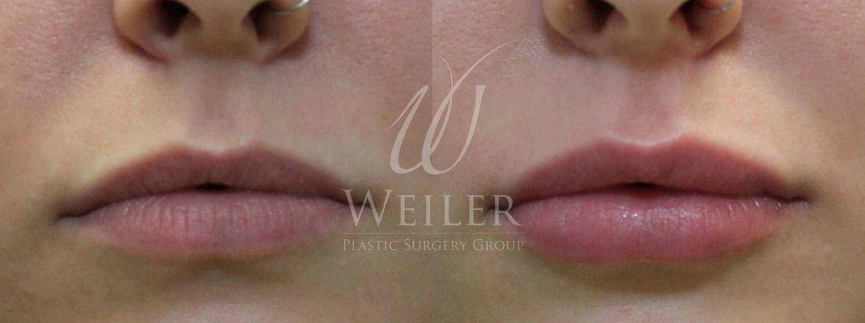 Before & After Lip Augmentation Case 532 Front View in Baton Rouge, New Orleans, & Lafayette, Louisiana