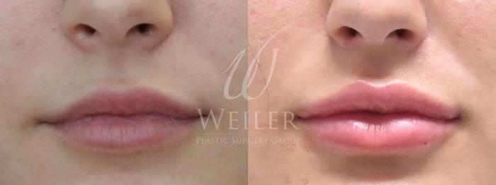 Before & After Lip Augmentation Case 616 Front View in Baton Rouge, Louisiana