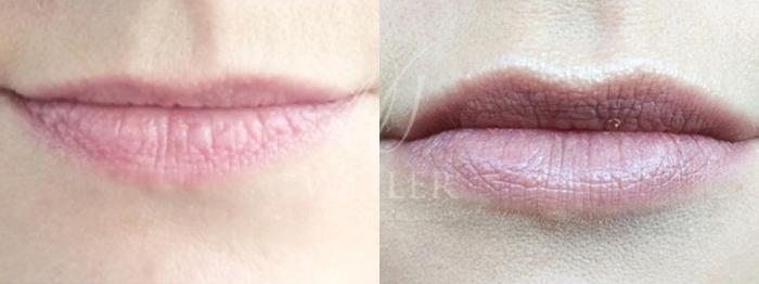 Before & After Lip Augmentation Case 8 View #1 View in Baton Rouge, Louisiana