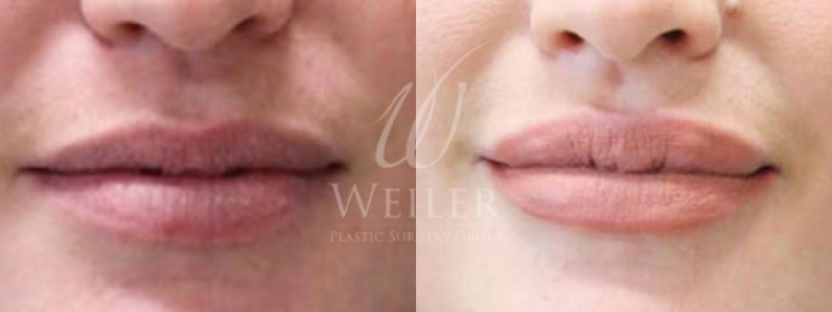 Before & After Lip Augmentation Case 9 View #1 View in Baton Rouge, Louisiana