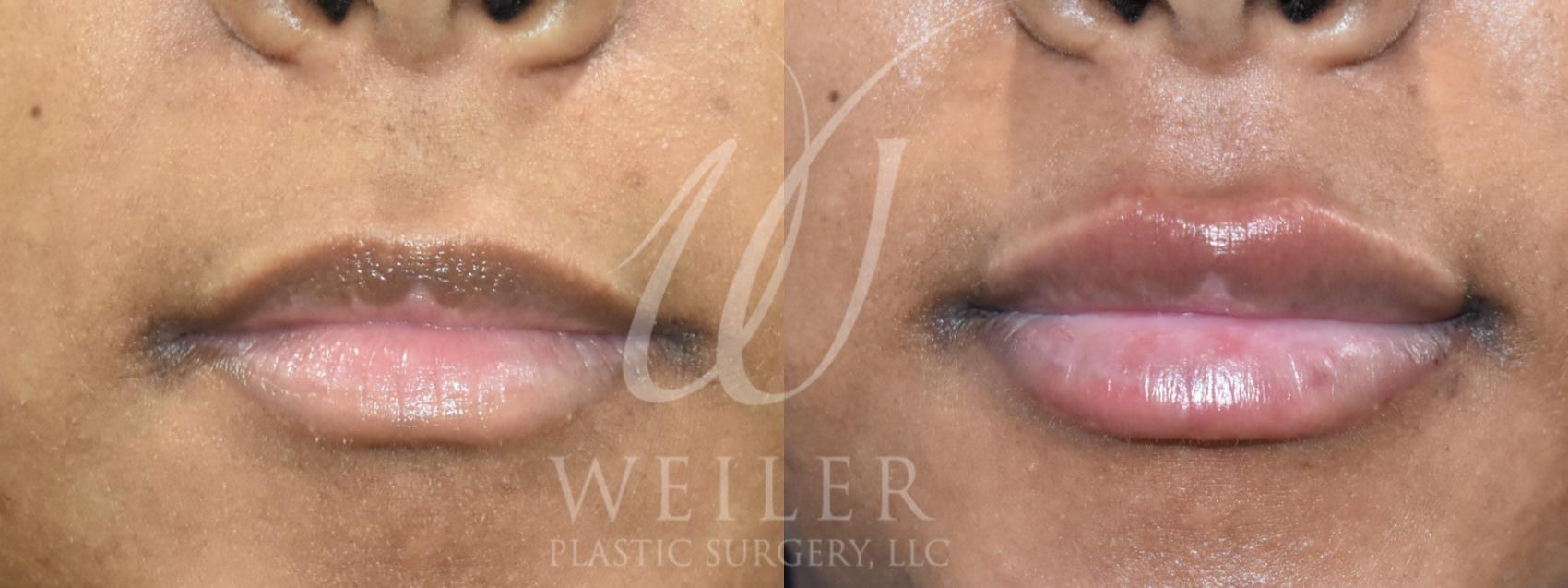 Before & After Lip Augmentation Case 930 Front View in Baton Rouge, Louisiana