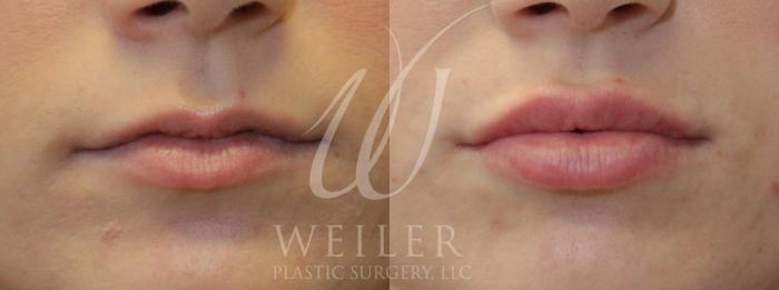 Before & After Lip Augmentation Case 949 Front View in Baton Rouge, Louisiana