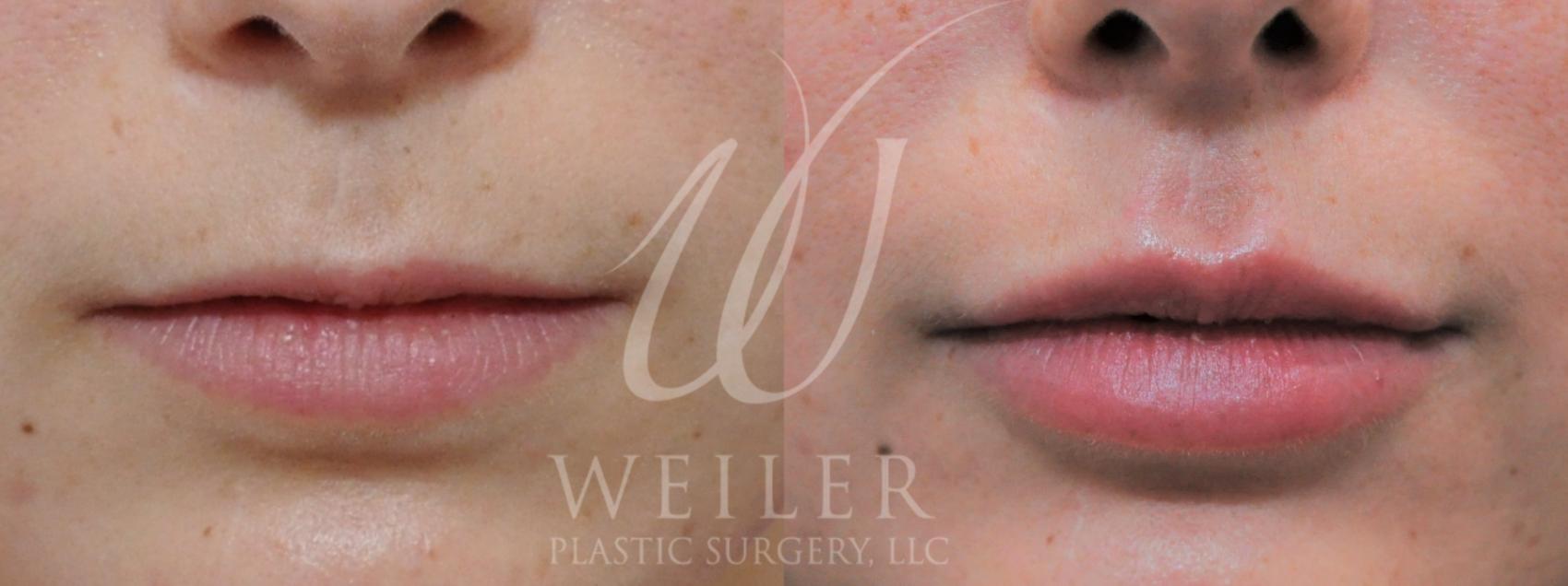 Before & After Lip Augmentation Case 950 Front View in Baton Rouge, New Orleans, & Lafayette, Louisiana