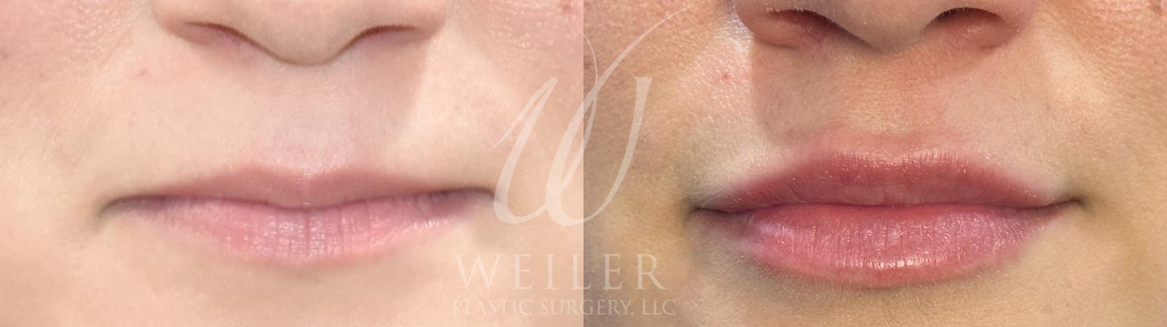 Before & After JUVÉDERM® Case 984 Front View in Baton Rouge, New Orleans, & Lafayette, Louisiana