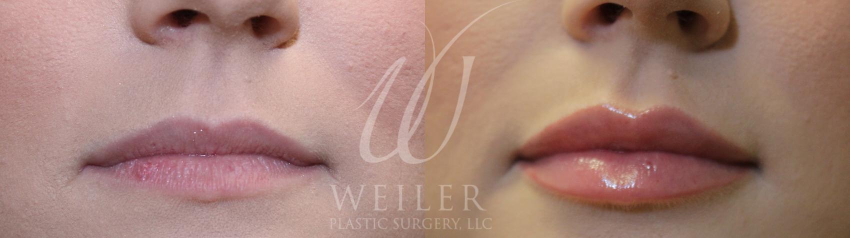 Before & After Lip Augmentation Case 985 Front View in Baton Rouge, Louisiana