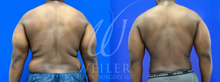 Before & After Liposuction Case 1081 Back View in Baton Rouge, New Orleans, & Lafayette, Louisiana