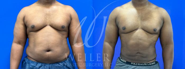 Before & After Liposuction Case 1081 Front View in Baton Rouge, New Orleans, & Lafayette, Louisiana