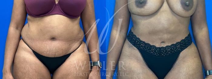 Before & After Liposuction Case 1103 Front View in Baton Rouge, New Orleans, & Lafayette, Louisiana