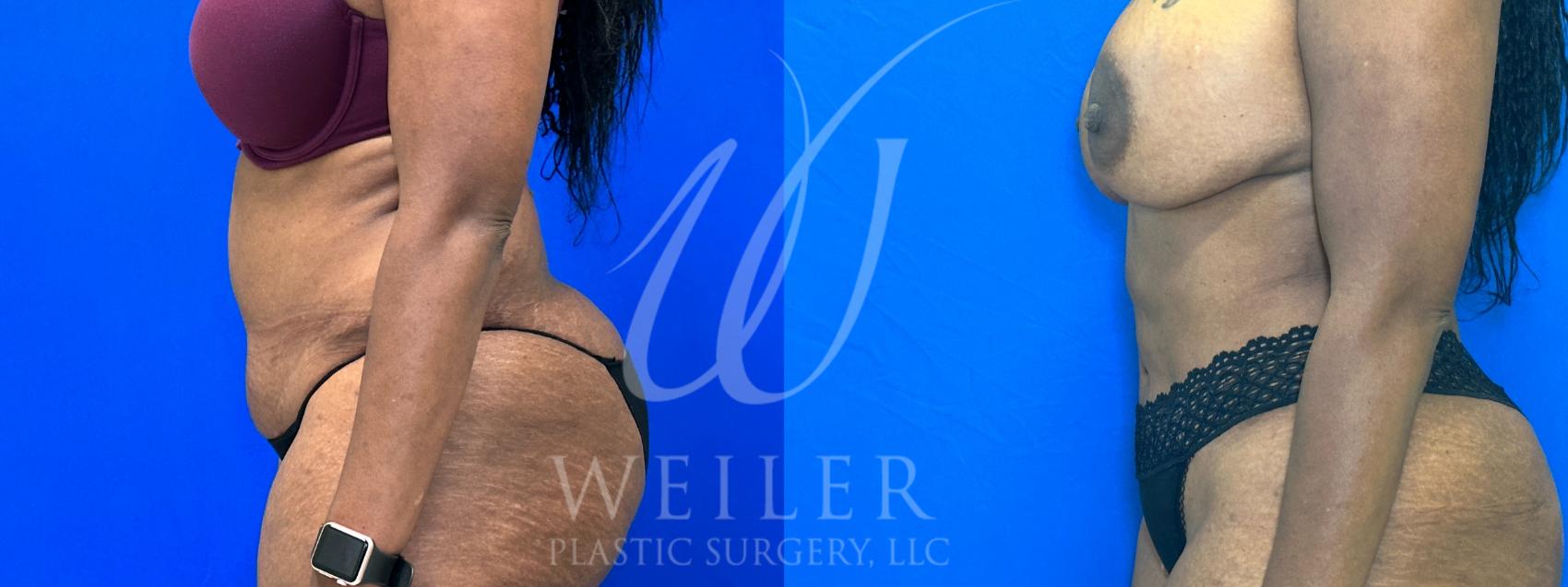 Before & After Liposuction Case 1103 Left Side View in Baton Rouge, New Orleans, & Lafayette, Louisiana