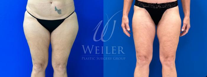 Before & After Liposuction Case 1115 Front View in Baton Rouge, New Orleans, & Lafayette, Louisiana