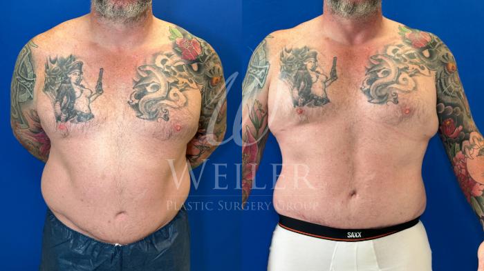 Before & After Liposuction Case 1263 Front View in Baton Rouge, New Orleans, & Lafayette, Louisiana