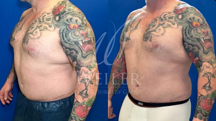 Before & After Liposuction Case 1263 Right Oblique View in Baton Rouge, New Orleans, & Lafayette, Louisiana