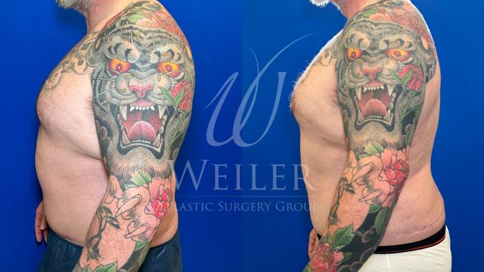 Before & After Liposuction Case 1263 Right Side View in Baton Rouge, New Orleans, & Lafayette, Louisiana