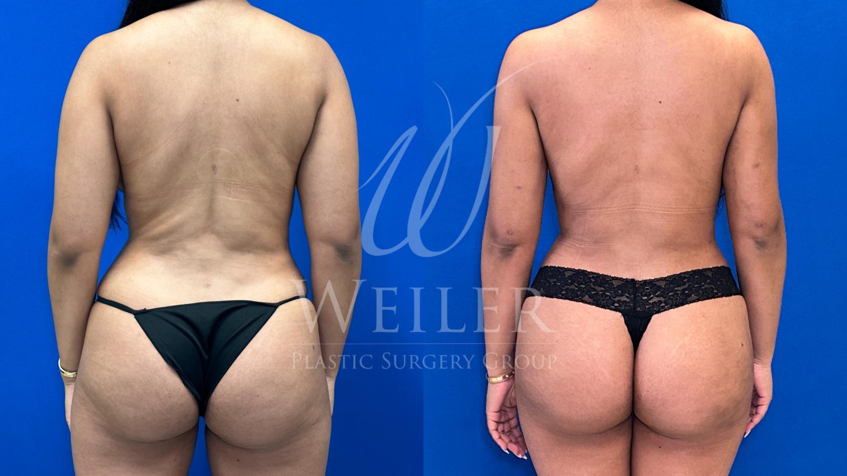 Before & After Liposuction Case 1326 Back View in Baton Rouge, New Orleans, & Lafayette, Louisiana