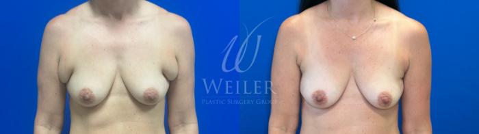 Before & After Liposuction Case 1338 Front View in Baton Rouge, New Orleans, & Lafayette, Louisiana