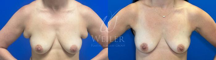 Before & After Liposuction Case 1338 Front View 2 View in Baton Rouge, New Orleans, & Lafayette, Louisiana